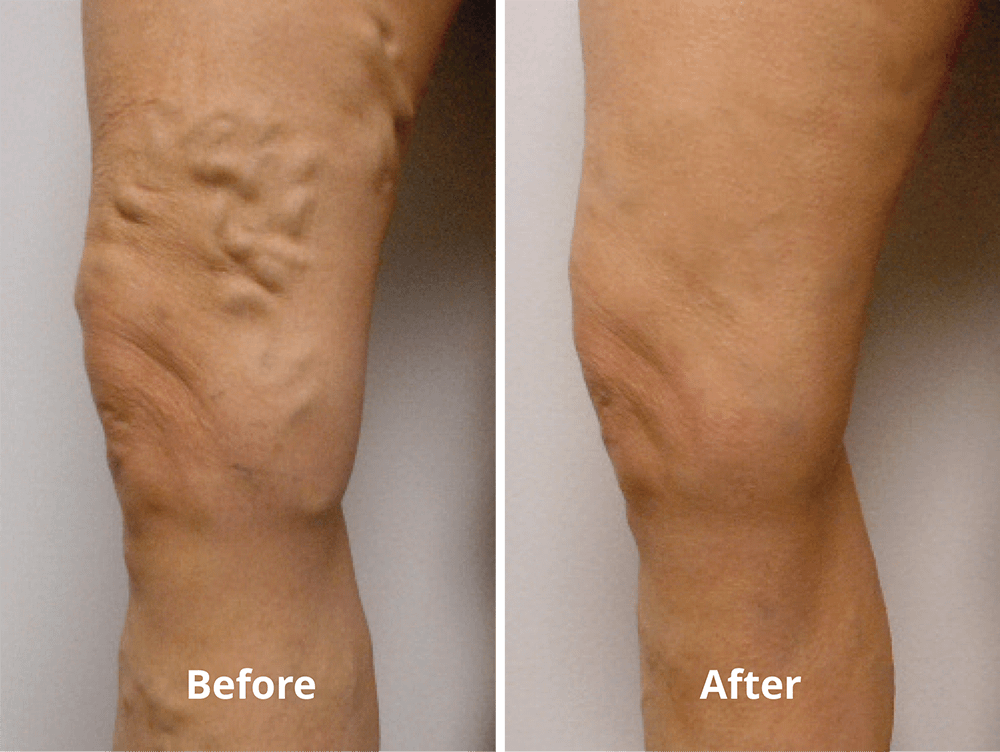 EVLT Before and After