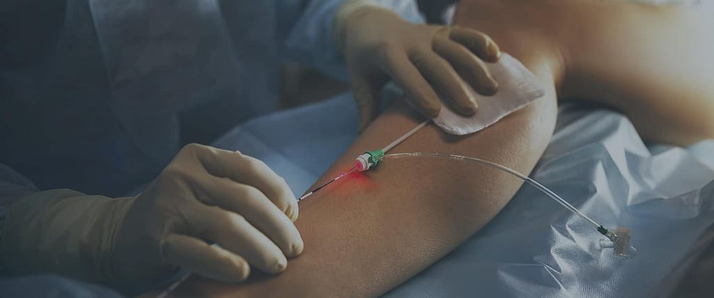 Endovenous Laser Ablation