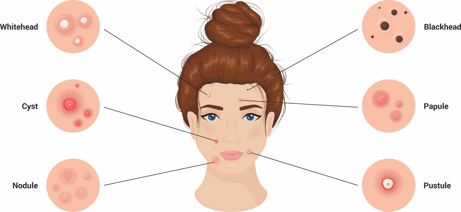 Acne 3 - OmniLase Acne classification