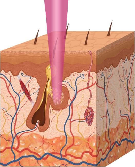 Acne 4 - OmniLase Laser treatment of acne
